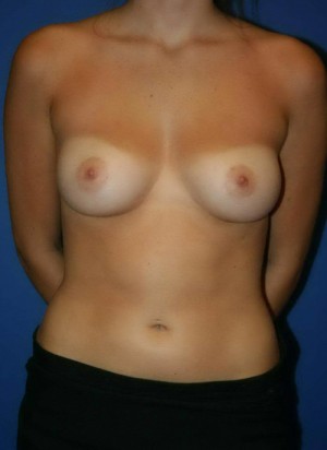 Breast Augmentation