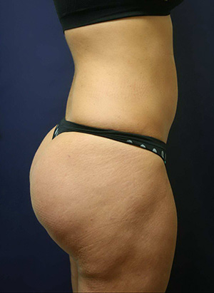 Brazilian Butt Lift Case 3711 After Photo Brazilian Butt Lift