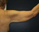 Brachioplasty – Arm Lift