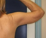 Brachioplasty – Arm Lift