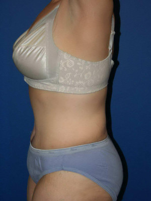 Tummy Tuck