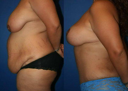 Liposuction Before & After Jacksonville