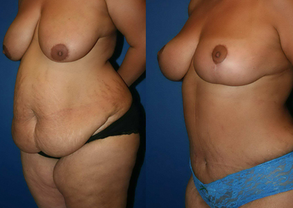 Liposuction Restults