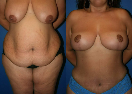 Liposuction Before & After Jacksonville